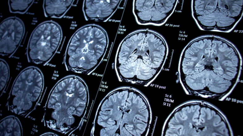 Modernising Clinical Trials in Neurological Pain