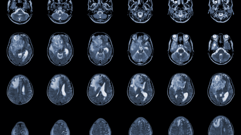 Glioblastoma: Symptoms, treatment and research advances